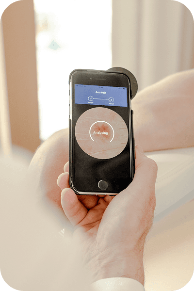 Dermascope being used to take a picture of a skin lesion